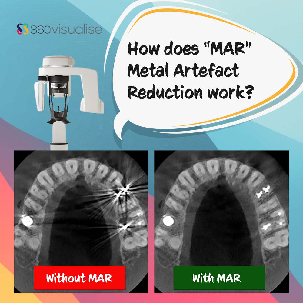 How does "MAR" Metal Artefact Reduction work on CBCT?