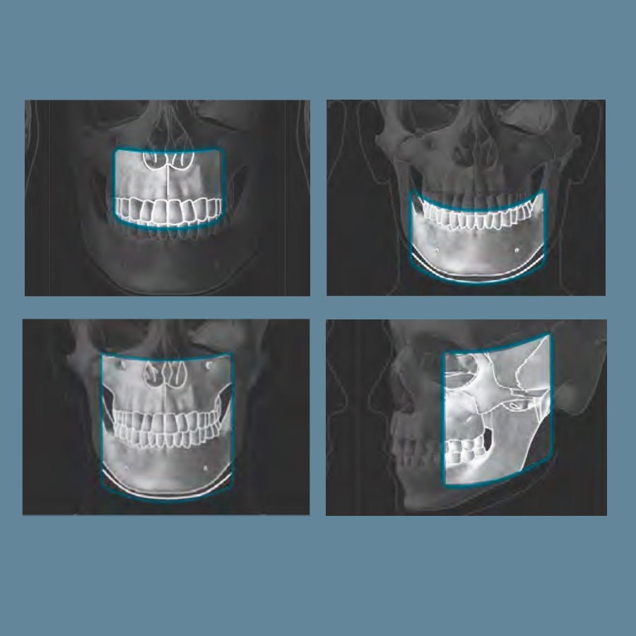 Cone Beam CBCT. What are the benefits for Dental Implant Planning? - 360visualise