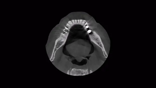Carestream Metal Artefact Reduction Upgrade (MAR) For CS8100 3D - Image 2
