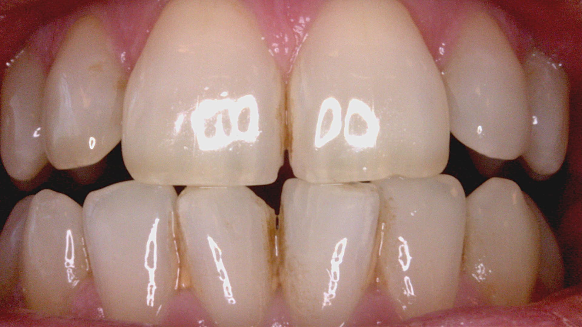 Acteon C20 clinical image 1 – Full HD intraoral detail