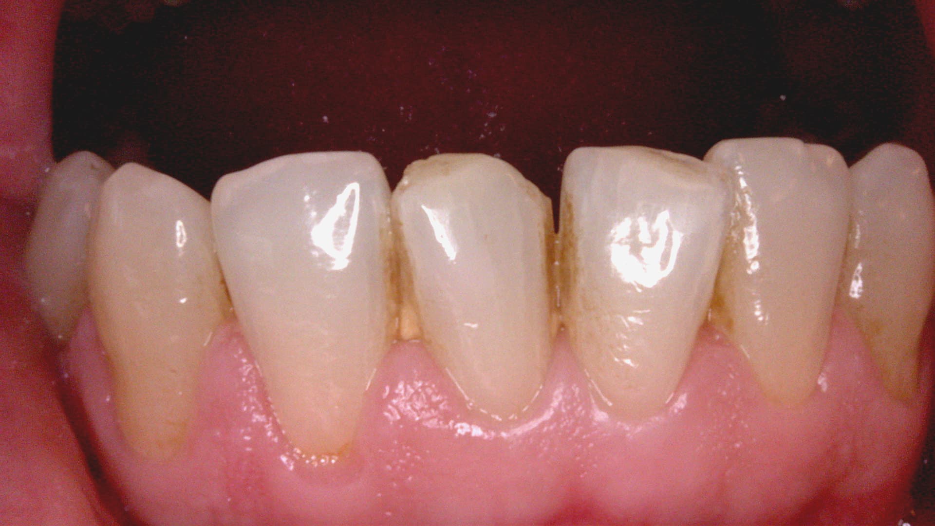 Acteon C20 clinical image 2 – Full HD intraoral detail