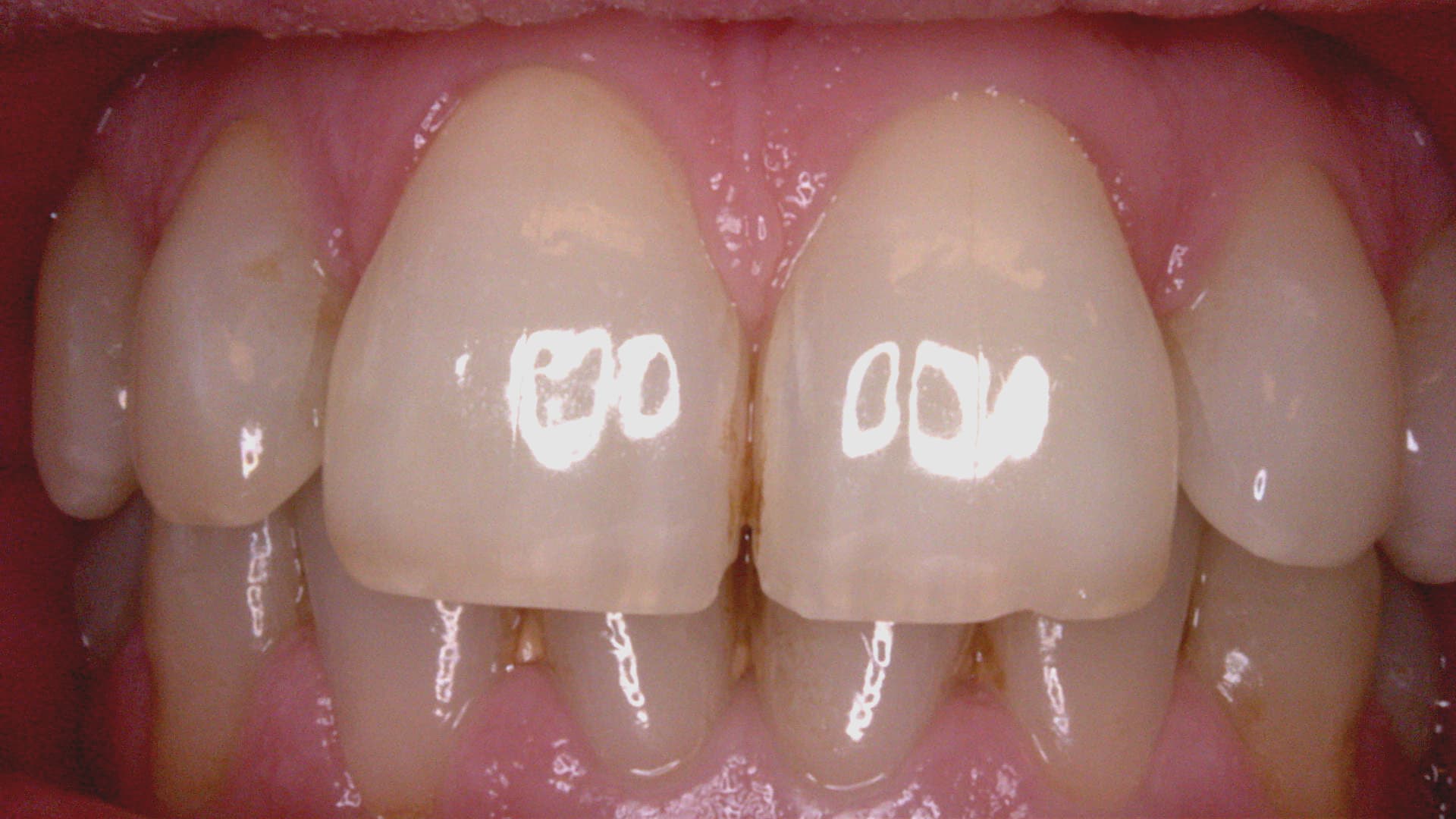 Acteon C20 clinical image 3 – Full HD intraoral detail