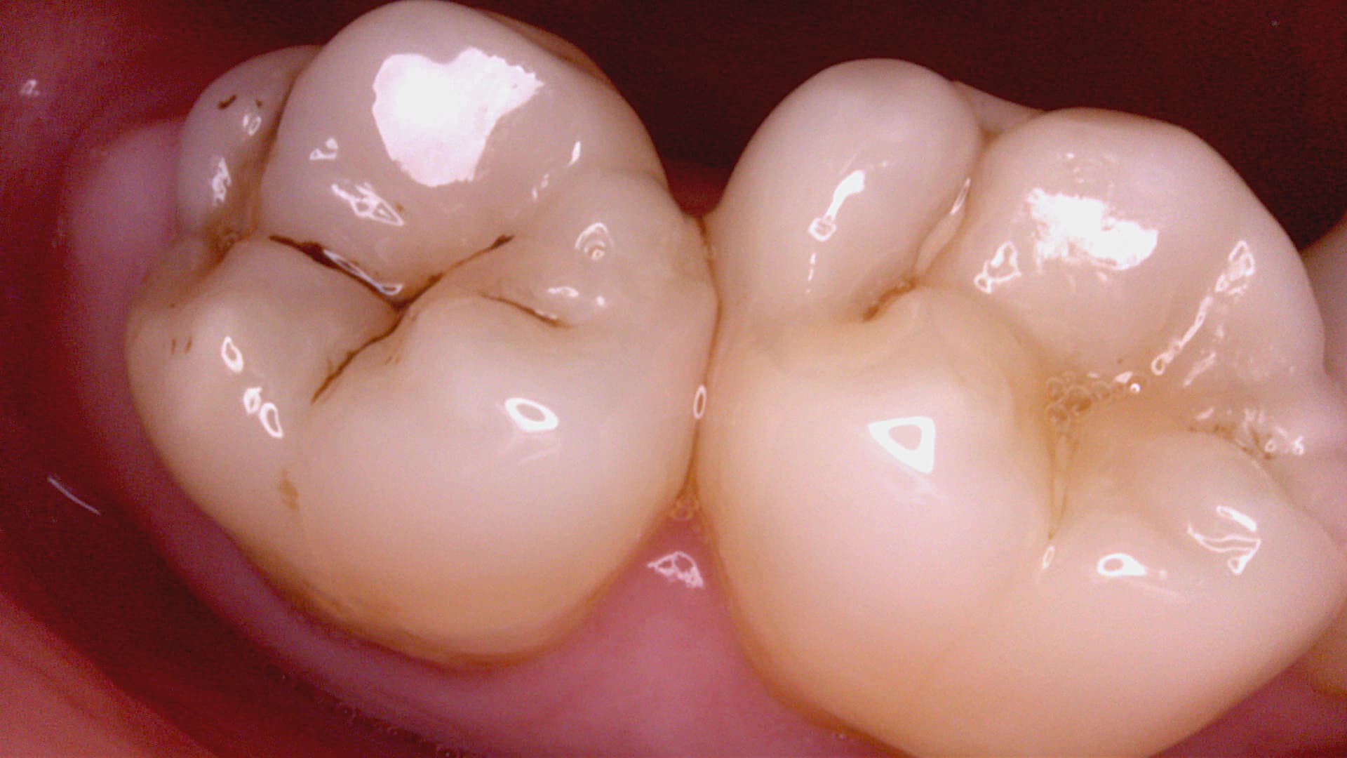 Acteon C20 clinical image 4 – Full HD intraoral detail