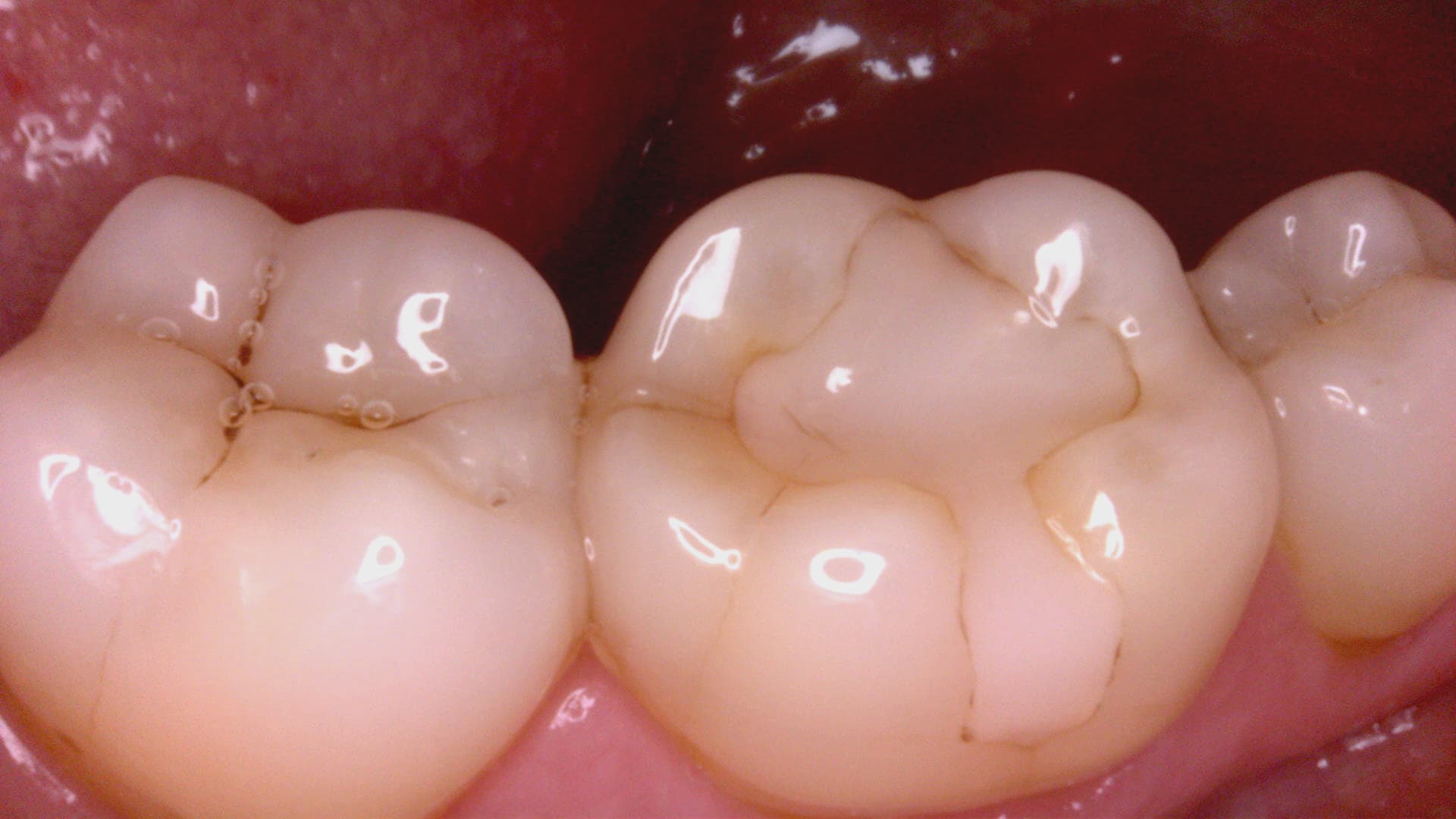 Acteon C20 clinical image 5 – Full HD intraoral detail