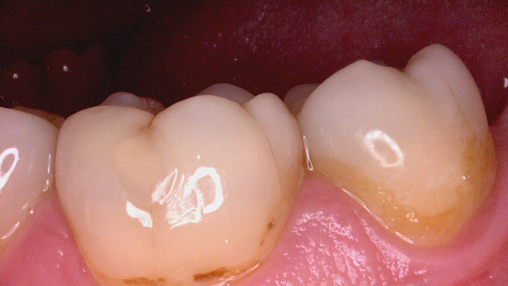 Acteon C20 clinical image 6 – Full HD intraoral detail