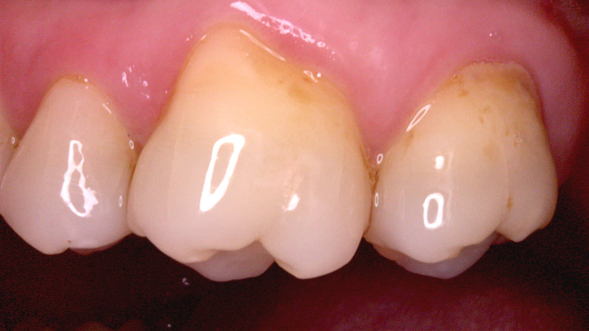 Acteon C20 clinical image 7 – Full HD intraoral detail