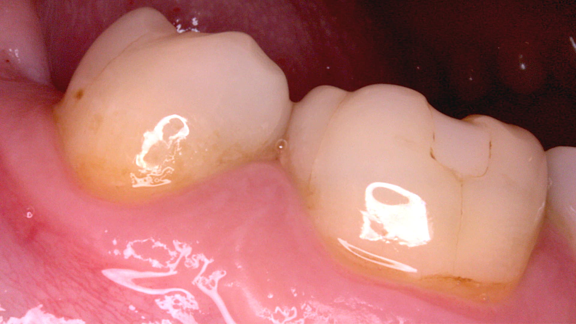 Acteon C20 clinical image 8 – Full HD intraoral detail