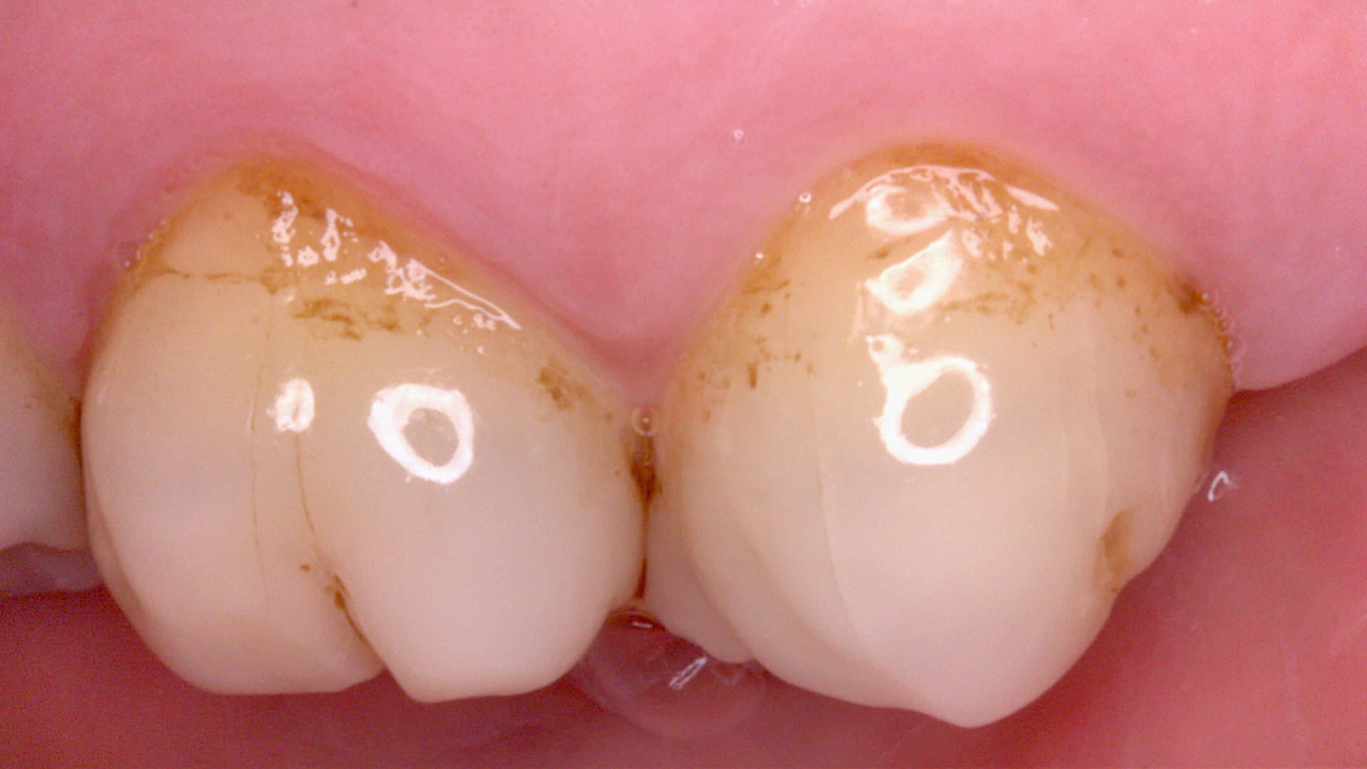 Acteon C20 clinical image 9 – Full HD intraoral detail