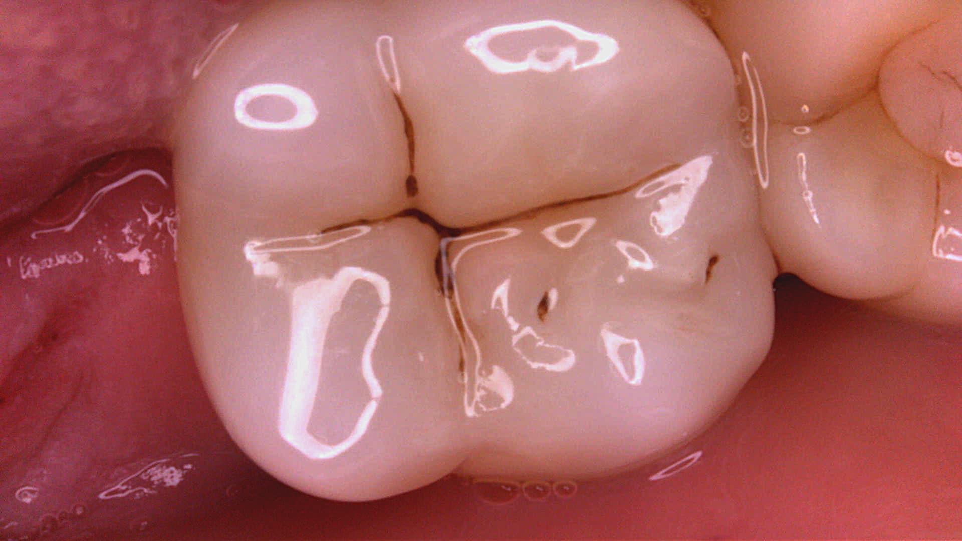 Acteon C20 clinical image 10 – Full HD intraoral detail