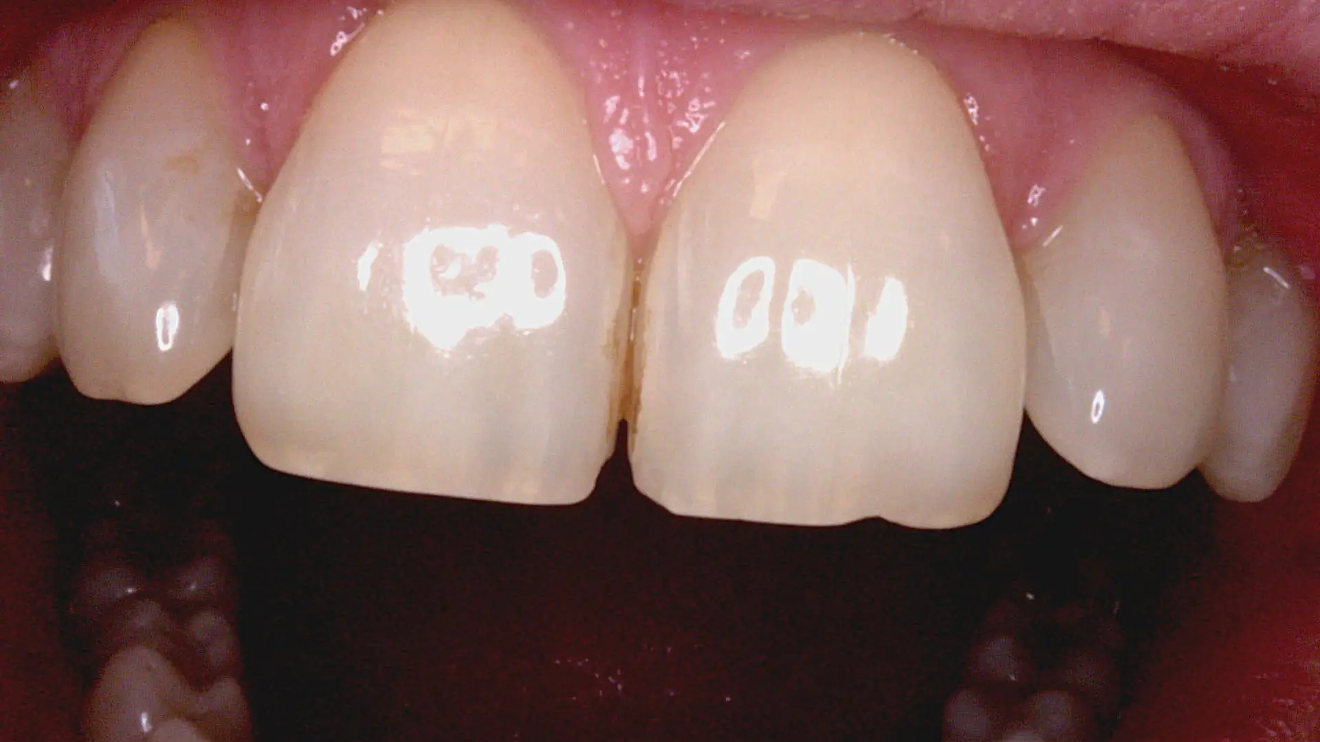 Acteon C20 clinical image 11 – Full HD intraoral detail