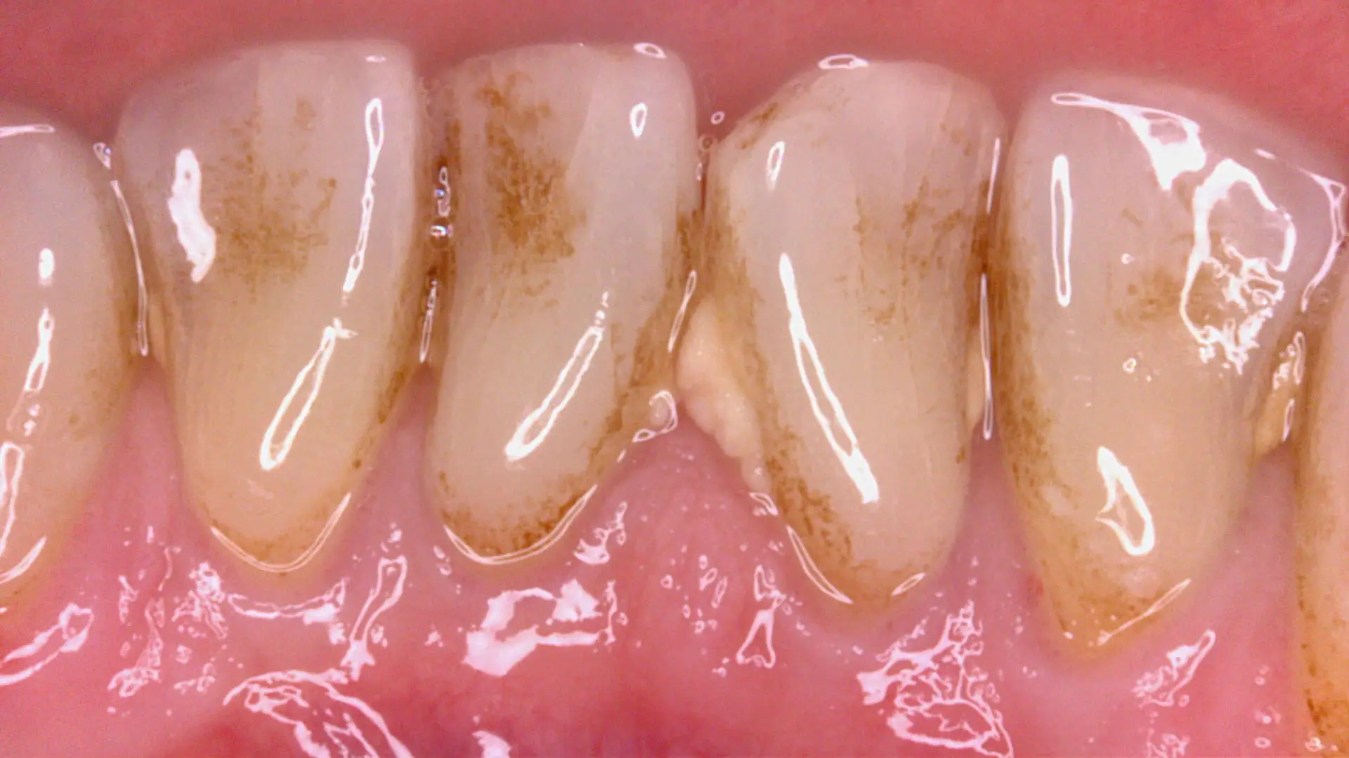 Acteon C20 clinical image 12 – Full HD intraoral detail