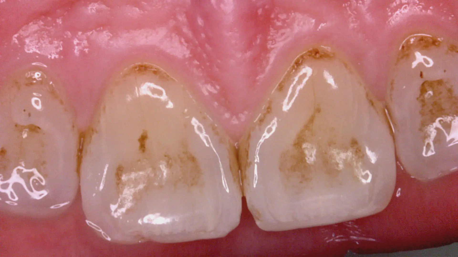 Acteon C20 clinical image 13 – Full HD intraoral detail