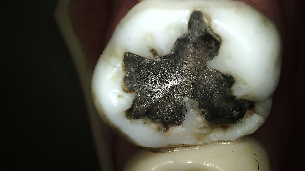 Carestream CS 1300 intraoral camera HD CMOS sensor clinical image showing tooth detail