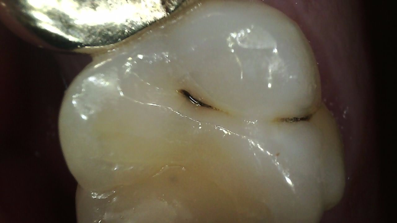 Carestream CS 1300 intraoral camera full arch clinical image 10 with HD clarity