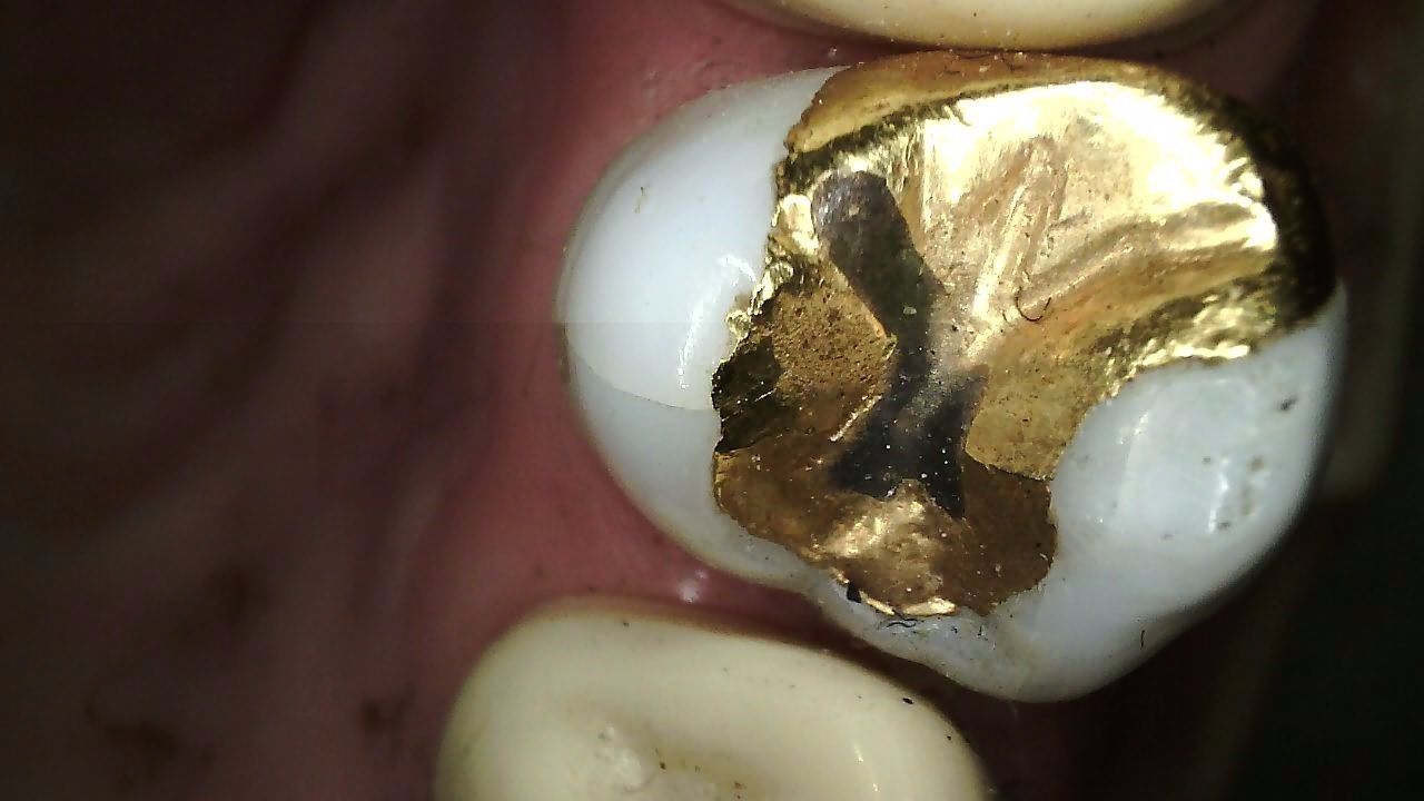 Full HD intraoral image captured using 280 degree rotating head on Carestream CS 1300