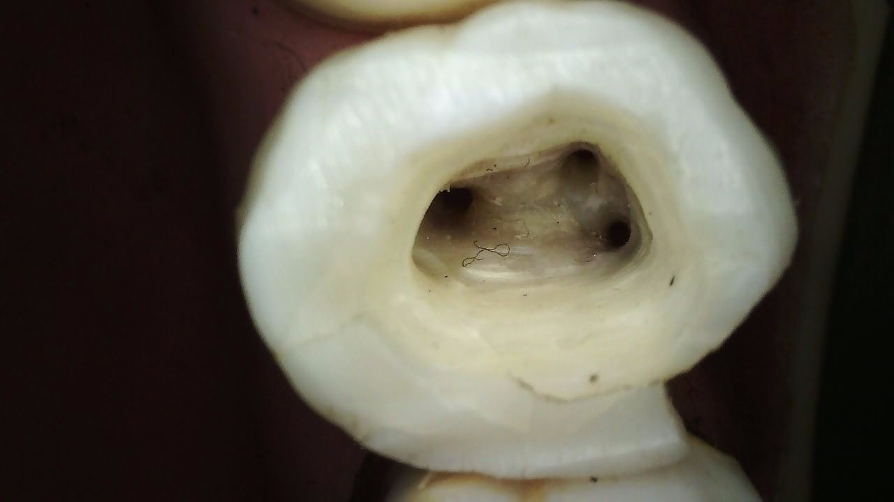 Carestream CS 1300 intraoral camera auto focus clinical image of posterior tooth