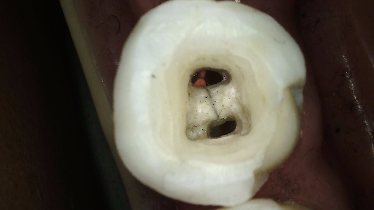 CS 1300 full HD intraoral camera image showing nine LED uniform illumination on posterior tooth