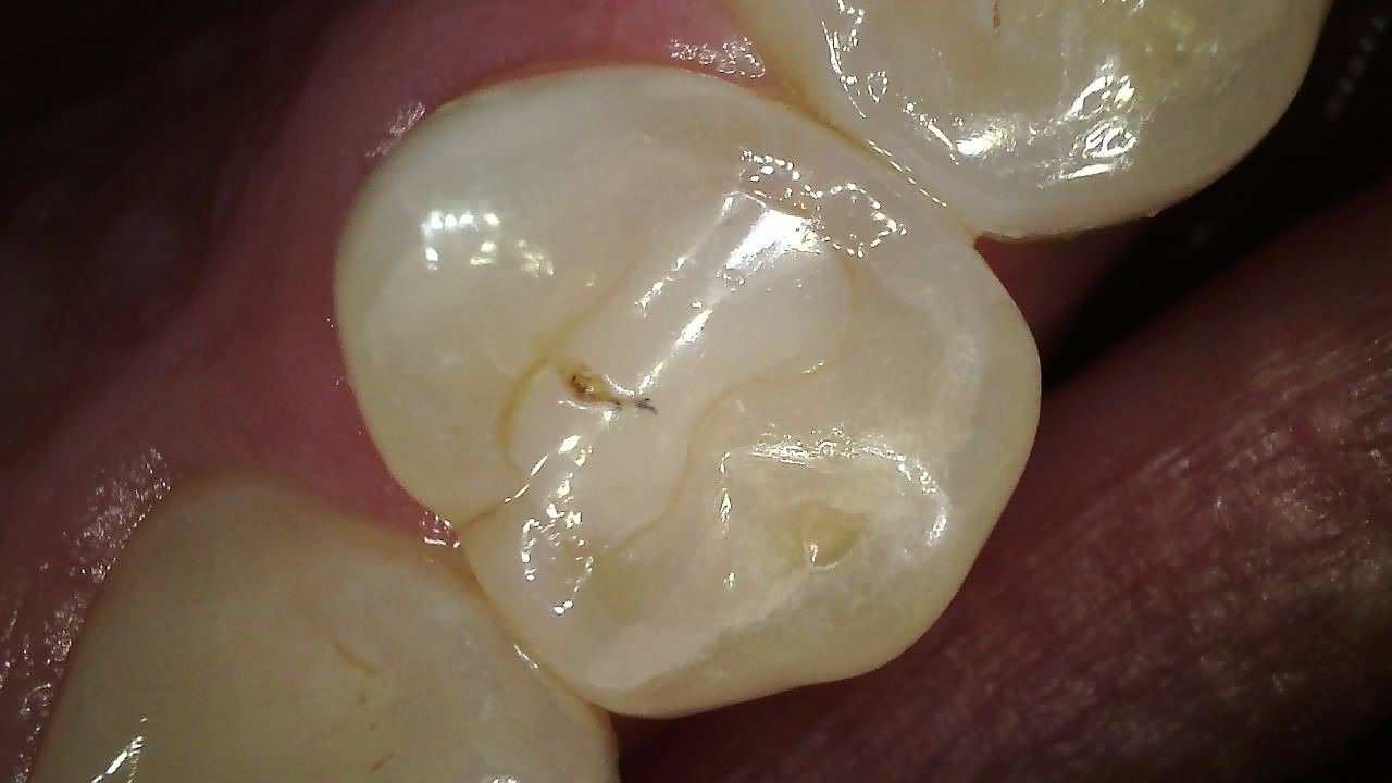 CS 1300 full HD intraoral camera macro clinical image showing fine tooth detail