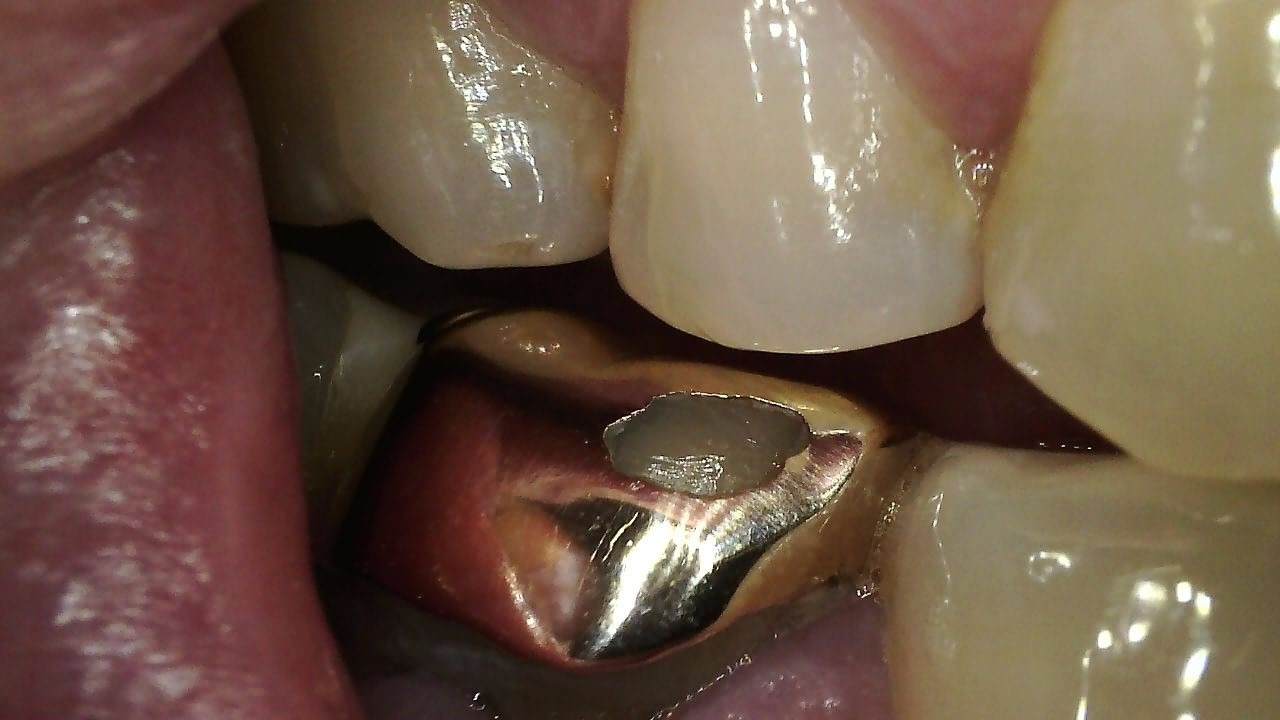 Full HD clinical image captured with Carestream CS 1300 intraoral camera showing posterior teeth detail