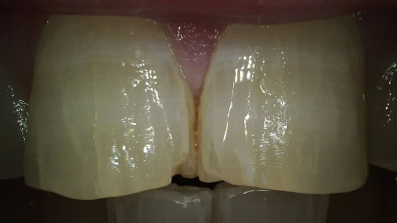 CS 1300 full HD intraoral camera clinical image 7 showing dental arch clarity