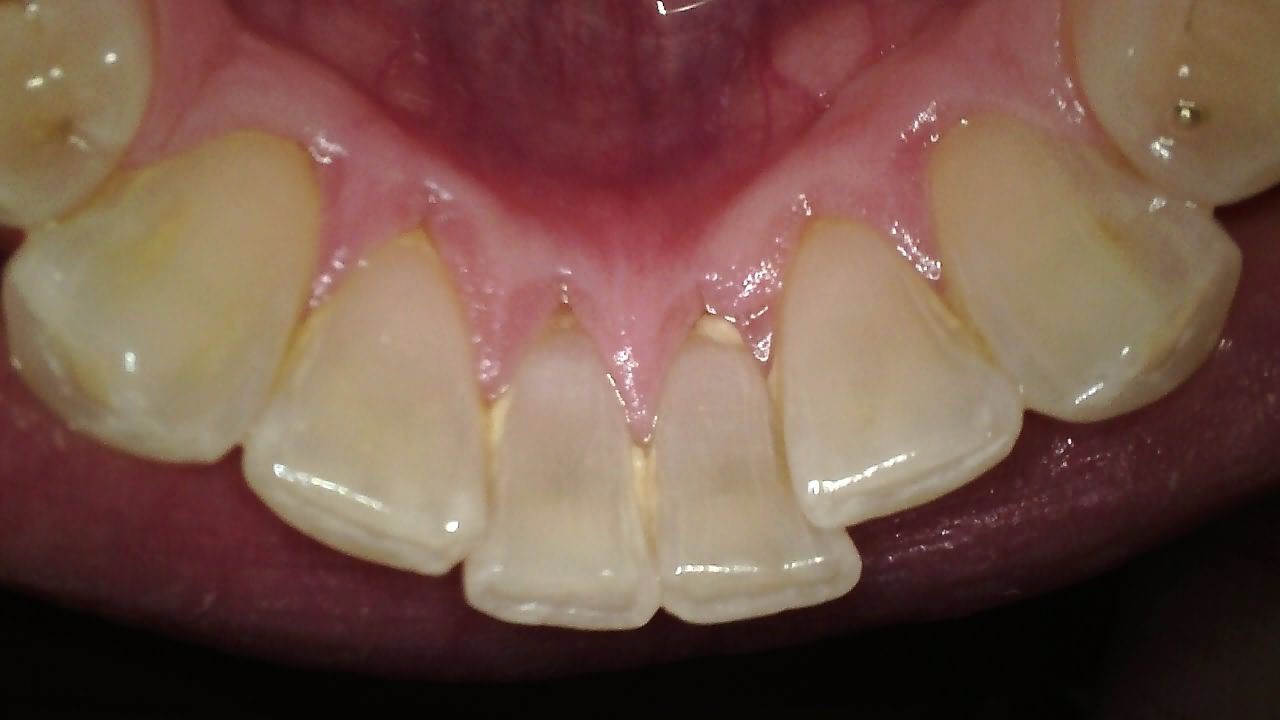 Carestream CS 1300 intraoral camera clinical image demonstrating semi-auto focus precision