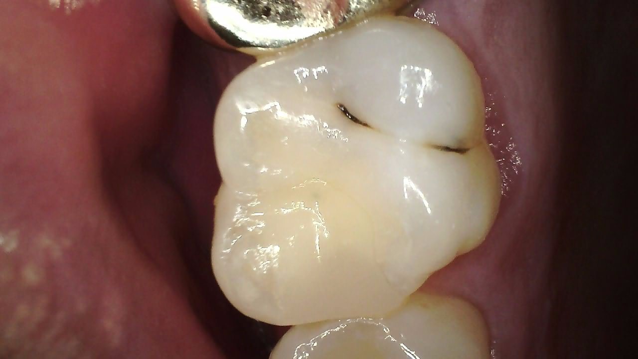 Carestream CS 1300 intraoral camera full arch view demonstrating wide focal range