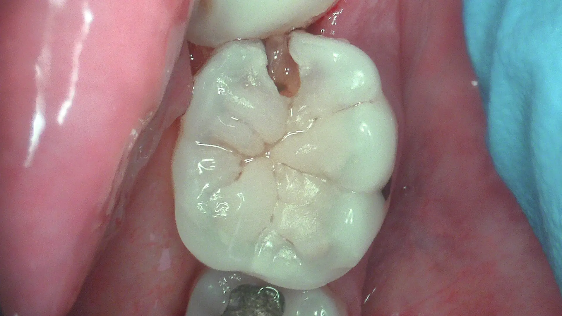 Acteon C50 – caries visible in daylight mode for comparison