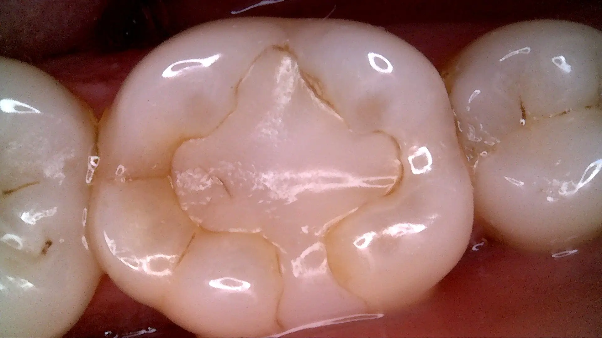 Acteon C20 clinical image 14 – Full HD intraoral detail