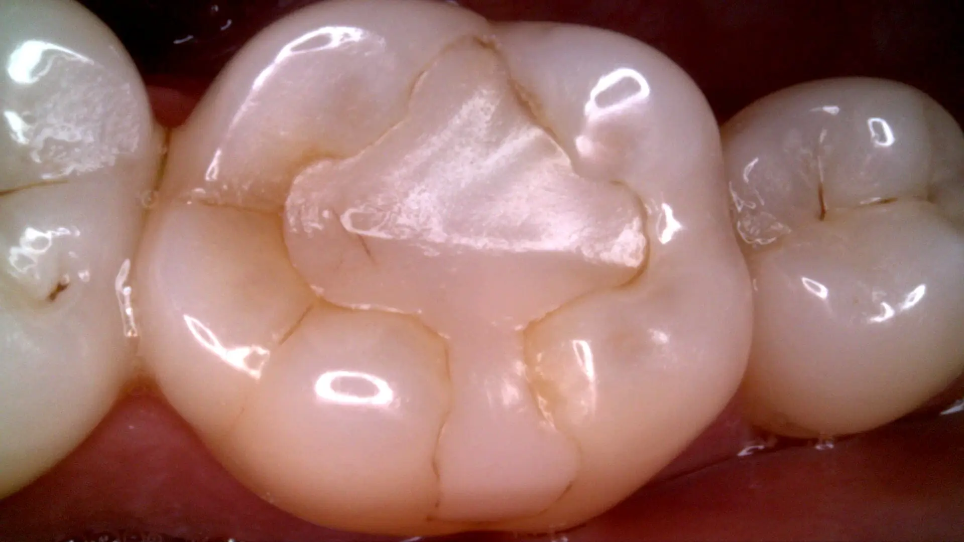 Acteon C20 clinical image 15 – Full HD intraoral detail