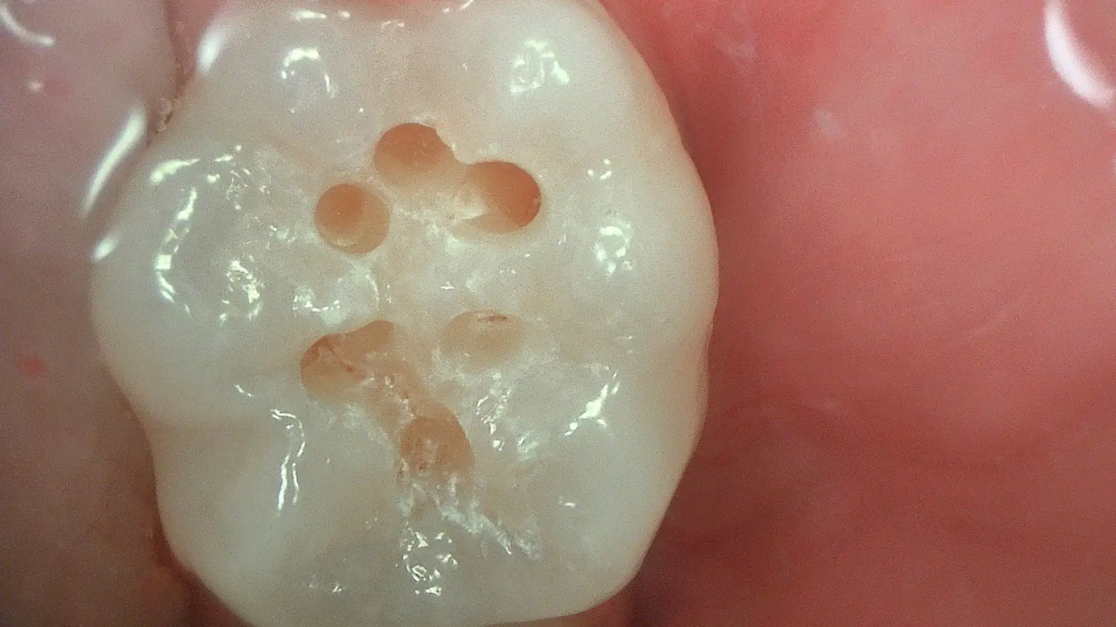 Acteon C50 – LR8 minimally invasive preparation stage 1