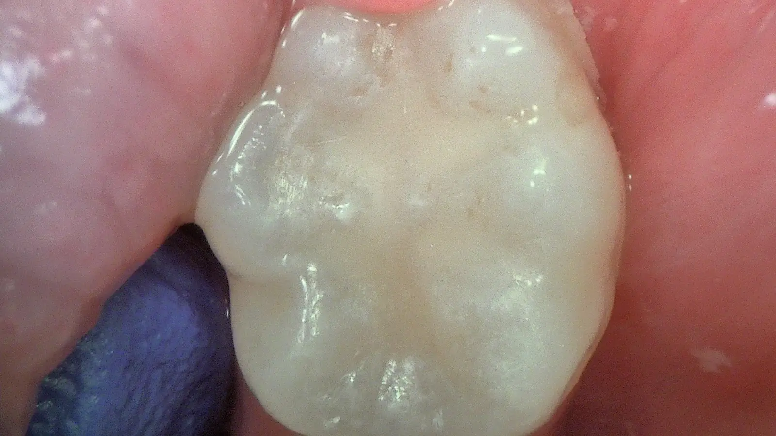 Acteon C50 – LR8 minimally invasive restoration stage 2