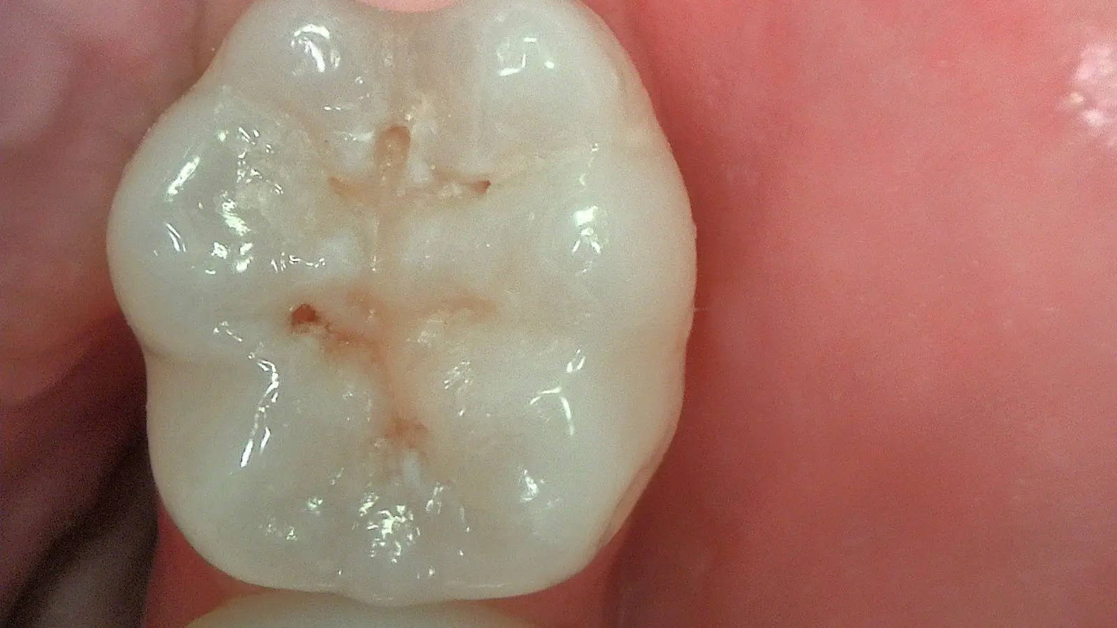 Acteon C50 – LR8 minimally invasive restoration stage 3