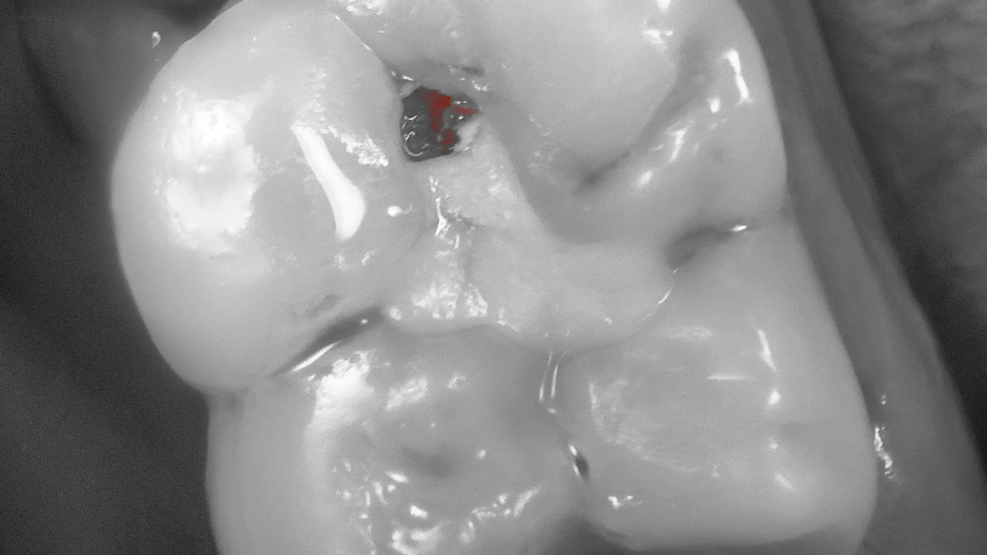 Acteon C50 – secondary caries case 2, fluorescence detection