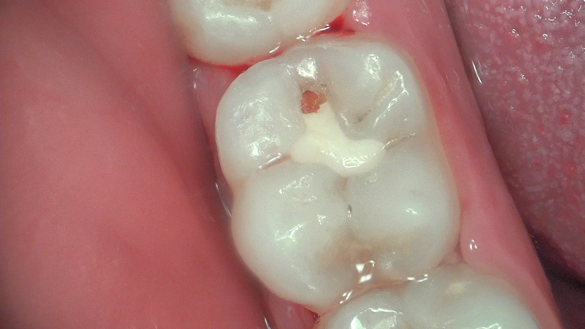 Acteon C50 – secondary caries detected beneath existing restoration
