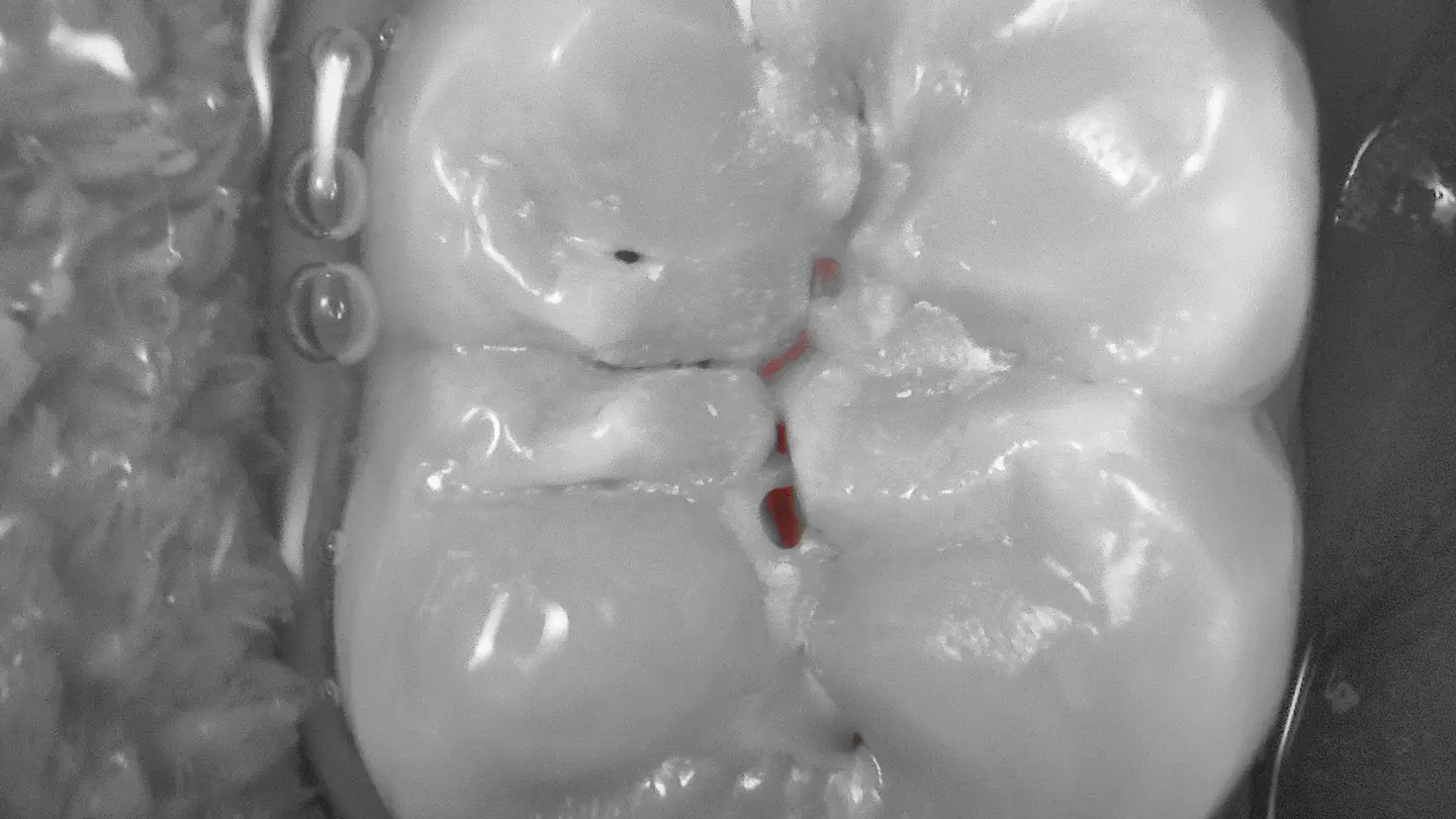 Acteon C50 Cario fluorescence mode – early caries highlighted in red