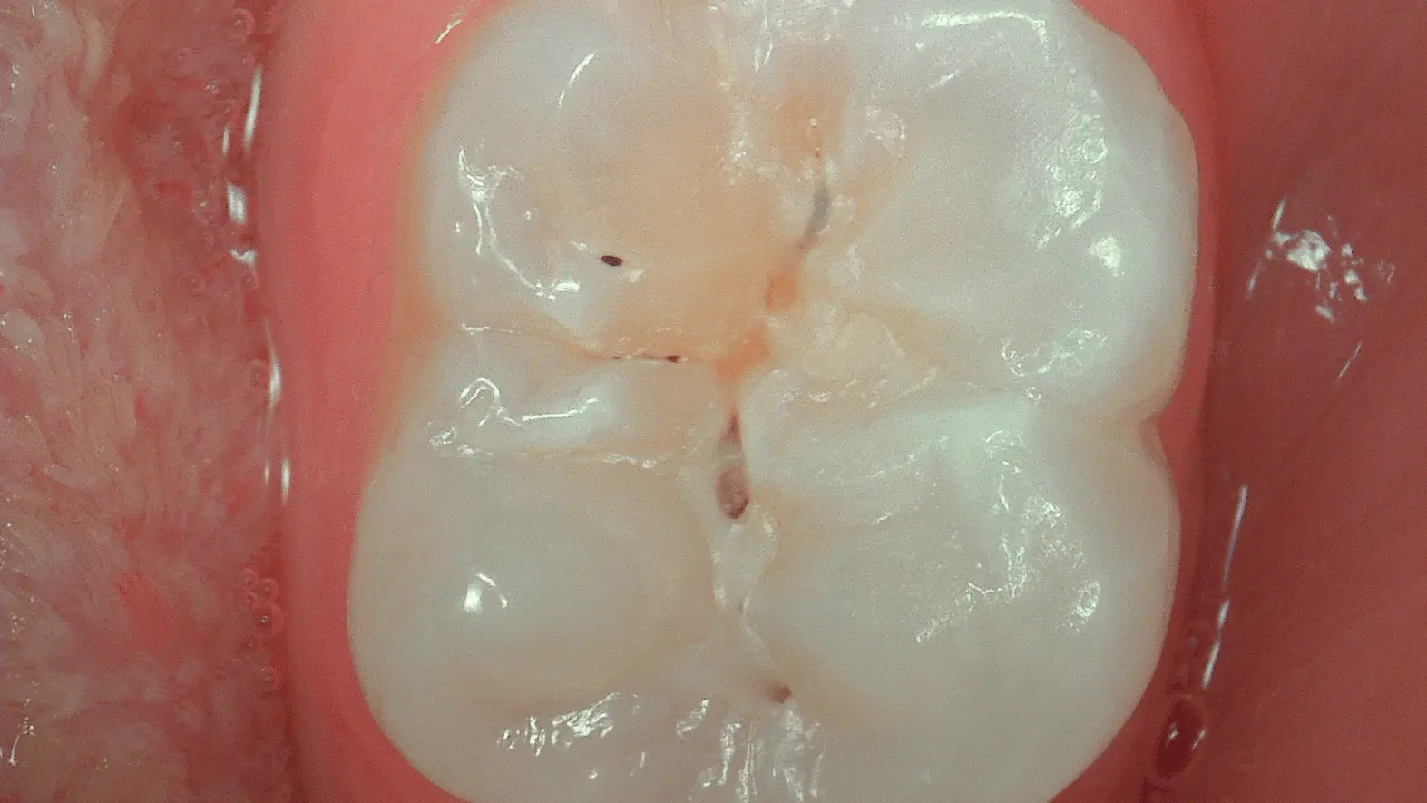 Acteon C50 Daylight mode – natural colour intraoral image