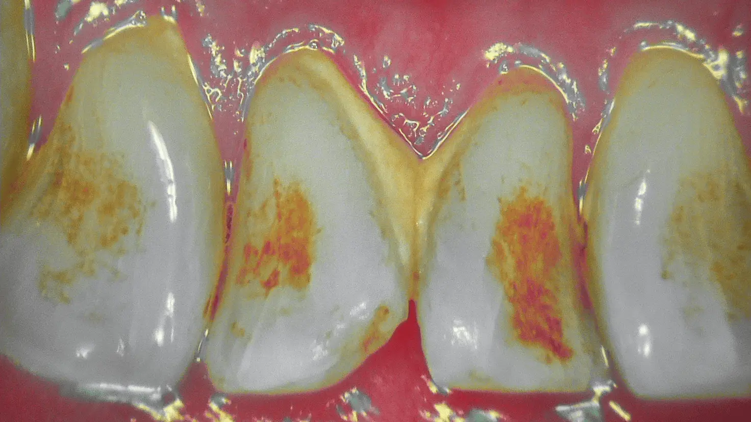 Acteon C50 Perio fluorescence mode – gingival inflammation detection