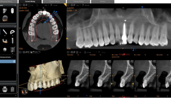 CBCT analysis within CS 3D Imaging software showing cross-sectional views of the implant site