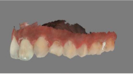 Digital impression captured with an intraoral scanner — buccal view