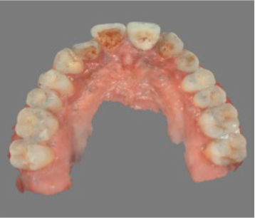 Digital impression captured with an intraoral scanner — occlusal view