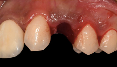 Guided drilling sequence — initial pilot drill through the surgical guide