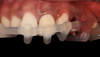 Guided drilling sequence — progressive osteotomy widening