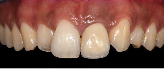Initial clinical situation showing displaced upper left canine