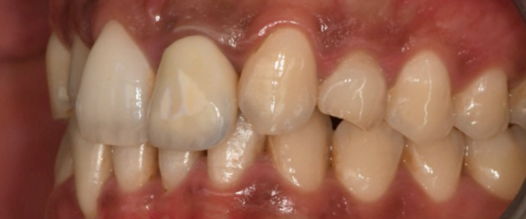 Initial occlusal view of the displaced canine site