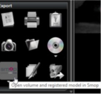 Implant planning data transferred from CS 3D Imaging to SMOP guided surgery software