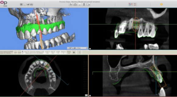 SMOP software displaying the transferred implant plan