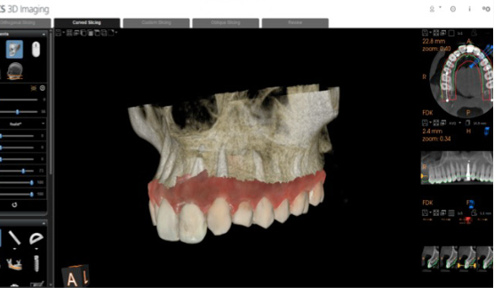 Prosthetic-driven implant planning in CS 3D Imaging software showing merged CBCT and intraoral scan data