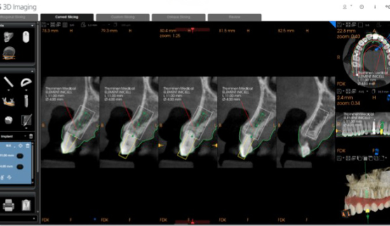 Implant position planned using crown-down approach in CS 3D Imaging