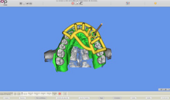 Surgical guide designed in SMOP software