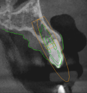 Surgical guide design detail in SMOP software
